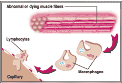 Muscle inflammation